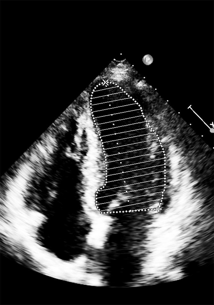 Ανακαλύπτοντας τη Δομή της Καρδιάς μέσω⁢ του Διαθωρακικού Υπερηχοκαρδιογραφήματος