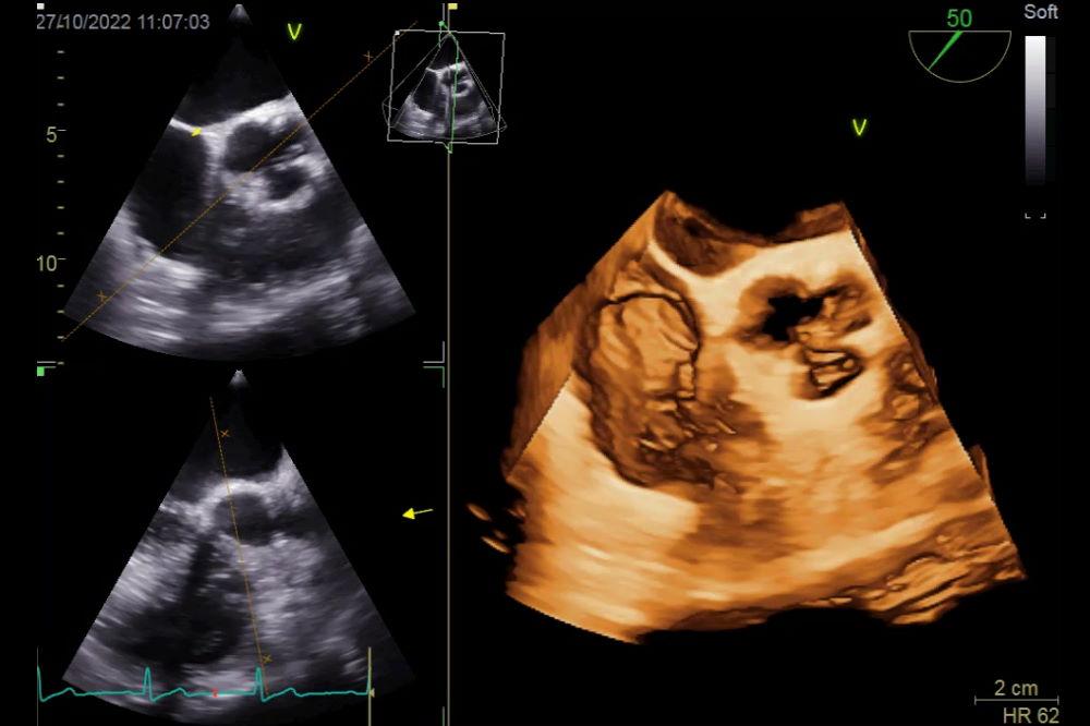 Ερμηνεύοντας τα‌ Αποτελέσματα: Τι μας Λέει το ⁢Υπερηχογράφημα για την Υγεία‍ της Καρδιάς